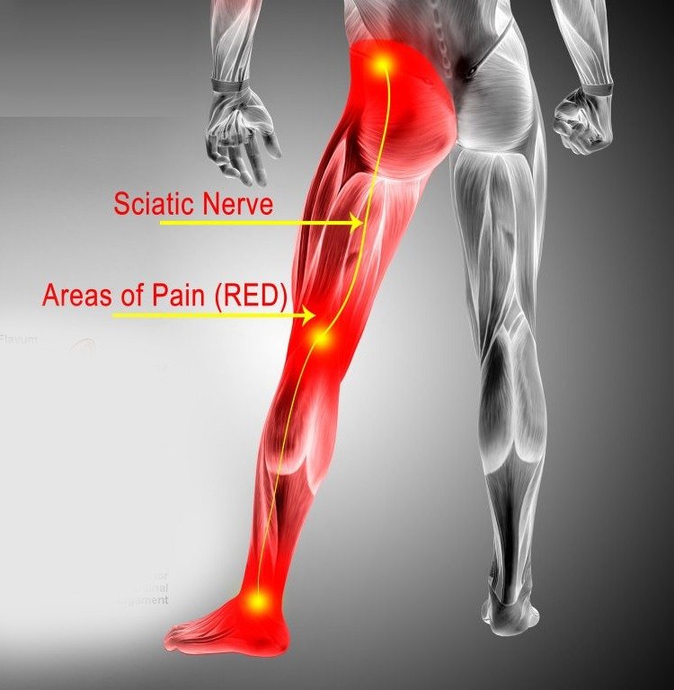 Sciatica Exercises: A Comprehensive Guide to Alleviate Pain.