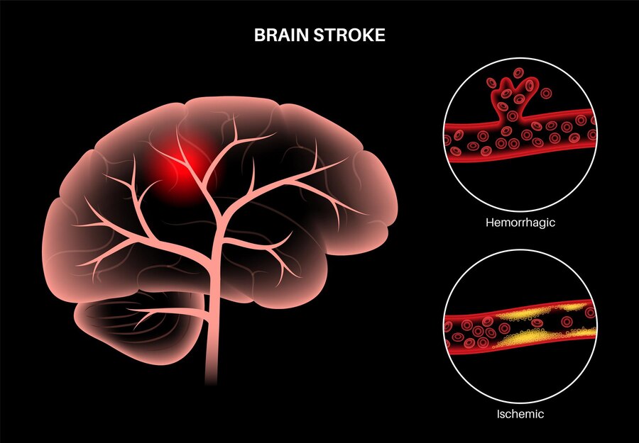 Nerve Pain in Multiple Sclerosis: Understanding the Impact