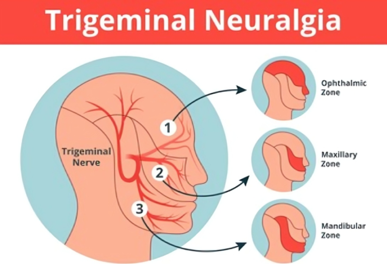 Suffering From Trigeminal Neuralgia New Treatment Options Offer Hope