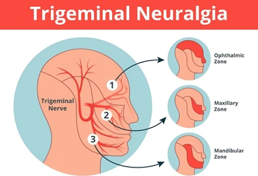 Trigeminal Neuralgia Treatment In Jhilmil