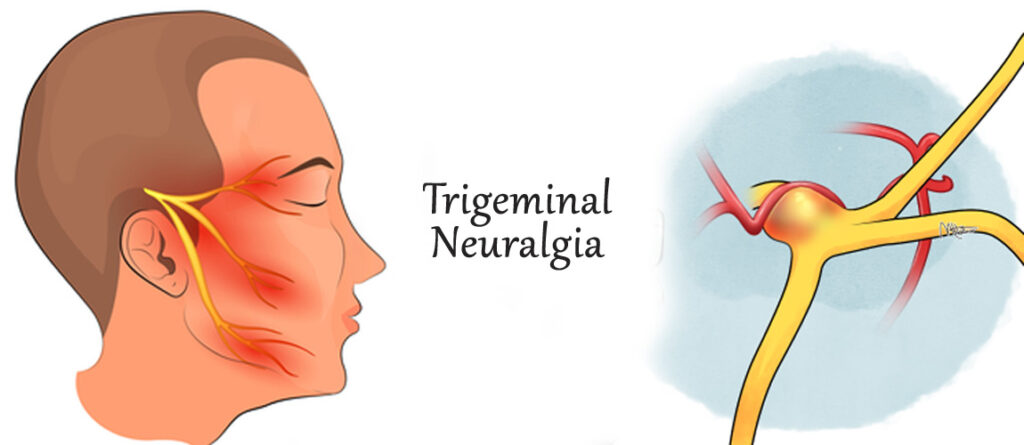 Best Trigeminal neuralgia treatment in Dilshad Garden