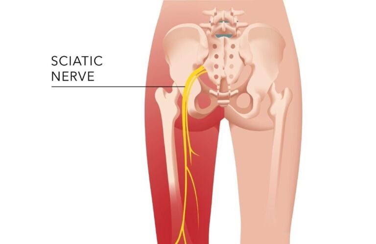 Best Sciatica Doctor in East Delhi