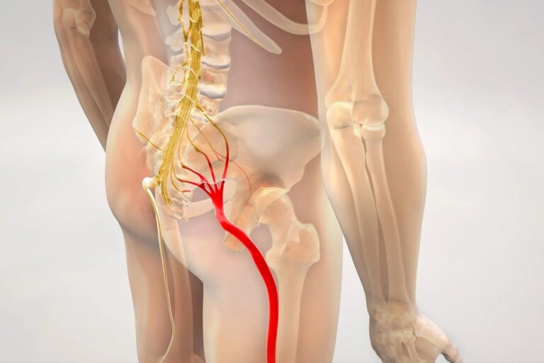 Sciatica Treatment in Dilshad Garden
