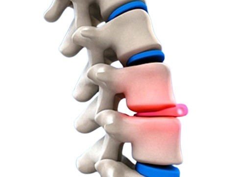 Slip Disc Specialist in Dilshad Garden